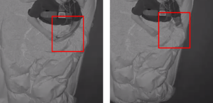 렘수면 행동장애 검사 그래프