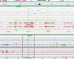 잠꼬대 증상 확인