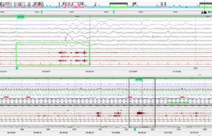 잠꼬대 신체 움직임