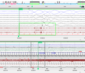렘수면 행동장애 소견