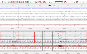 수면무호흡증 저호흡 소견