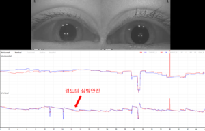 비디오안진검사