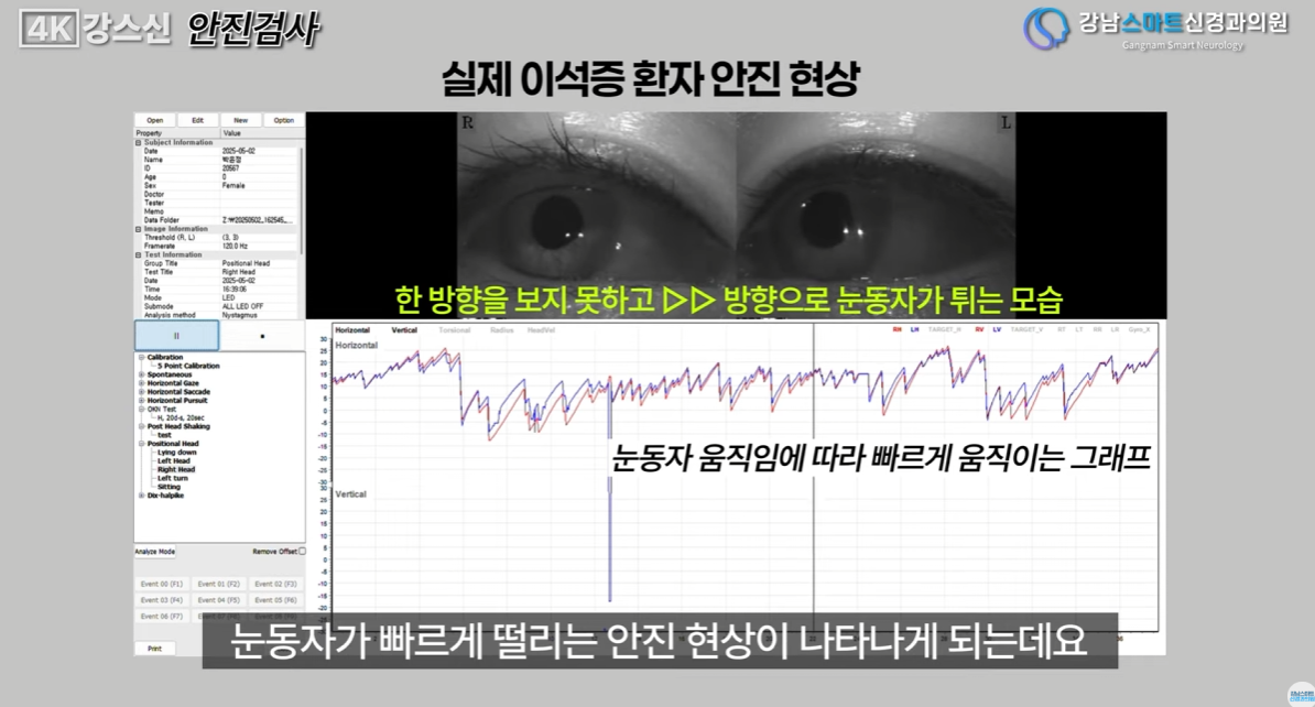 메니에르병 원인 검사 방법