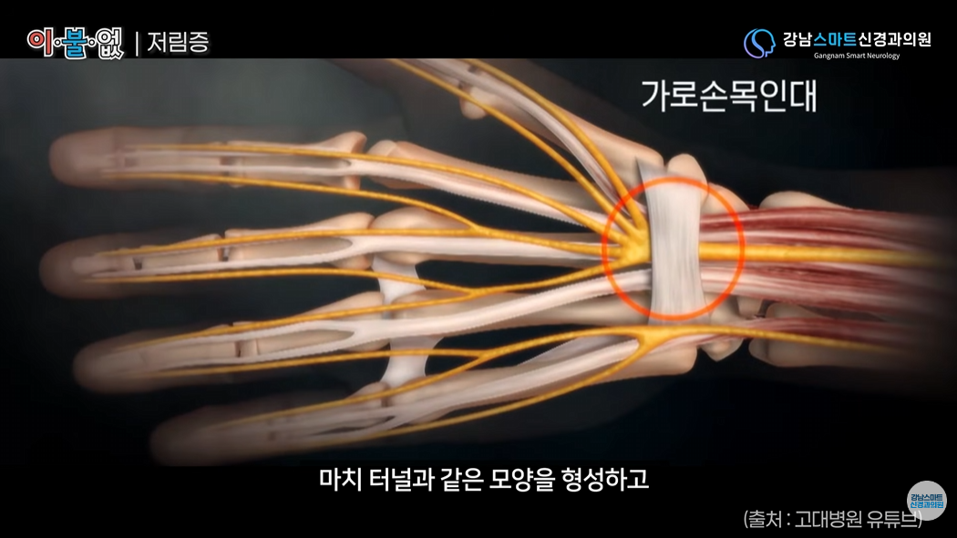 손가락 저림 손목 신경 사진