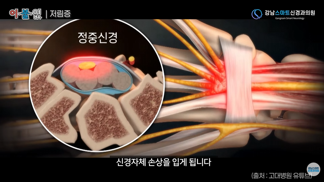 손가락 저림 정중신경