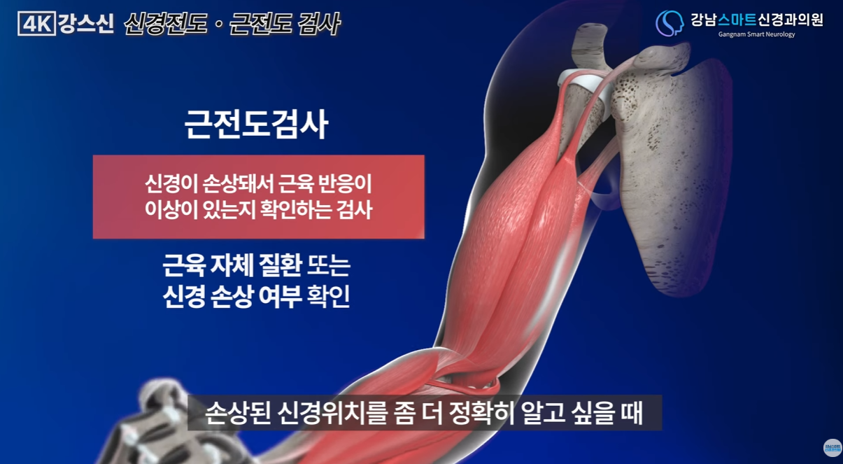 근전도 검사가 필요한 이유