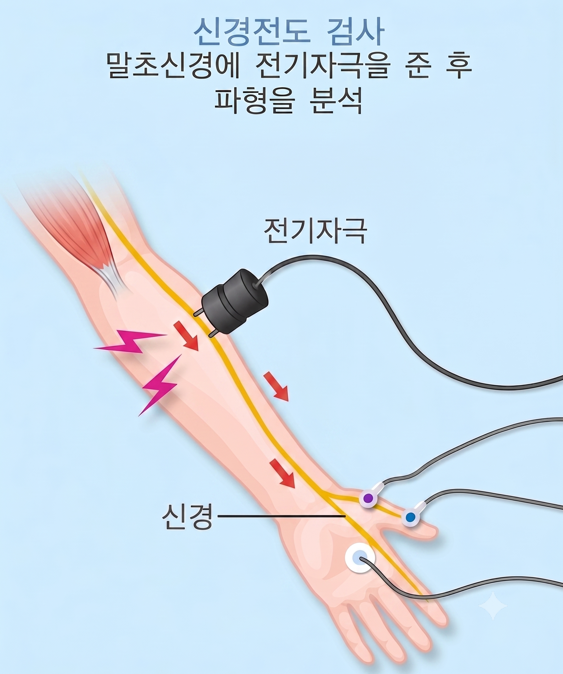 신경전도 검사 개념 설명